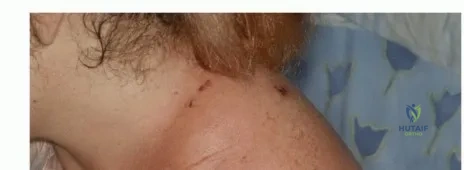 صورة طبية: بتر الربع الأمامي: كل ما يجب أن تعرفه عن هذا الإجراء المعقد