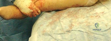 صورة طبية: إتقان توازن الأنسجة الرخوة لمفصل ورك صناعي مثالي: دليل شامل للمرضى مع الأستاذ الدكتور محمد هطيف