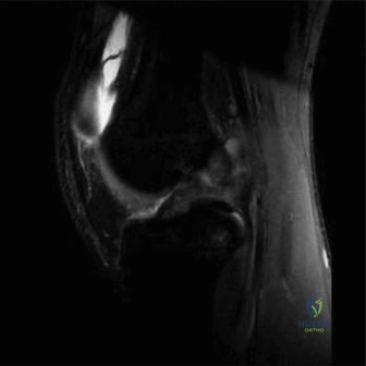 صورة طبية: التهاب العظم والغضروف السالخ وإصابات الركبة الأخرى لدى الأطفال: دليل شامل للآباء