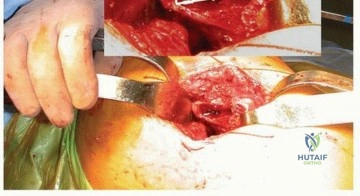 صورة توضيحية لـ السيقان المخروطية المزدوجة في مفصل الورك: ثبات يدوم لسنوات طويلة مع الأستاذ الدكتور محمد هطيف