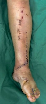 Illustration of anterolateral and medial - Dr. Mohammed Hutaif