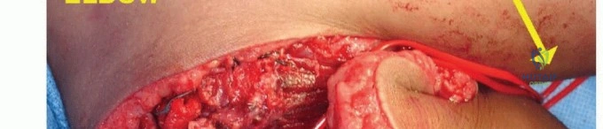 صورة طبية: استئصال الجزء البعيد من عظم العضد: تقنيات آمنة للحفاظ على الطرف في صنعاء مع الأستاذ الدكتور محمد هطيف