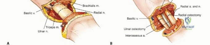 صورة توضيحية لـ بتر الذراع فوق وتحت الكوع: متى ولماذا يصبح ضرورة طبية؟ دليل شامل من الأستاذ الدكتور محمد هطيف