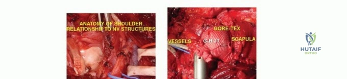صورة طبية: استئصال الجزء القريب من عظم العضد بتقنيات الحفاظ على الطرف: دليل شامل للمرضى مع الأستاذ الدكتور محمد هطيف