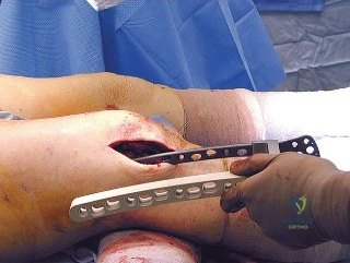 صورة طبية: كسور الفخذ حول المفصل الصناعي للركبة: دليل الأستاذ الدكتور محمد هطيف للتعافي الآمن