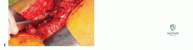 قطع المدور الكبير (Trochanteric Osteotomy)