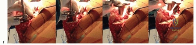 صورة طبية: جراحة مراجعة مفصل الركبة: تقنيات آمنة لإزالة المكونات الثابتة واستعادة الحركة مع الأستاذ الدكتور محمد هطيف في صنعاء