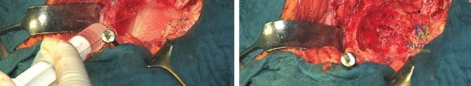 صورة طبية: جراحة استبدال مفصل الورك الملتهب في مرحلة واحدة: حل فعال وشامل مع الأستاذ الدكتور محمد هطيف