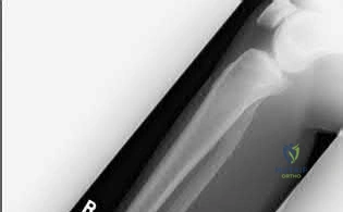 صورة طبية: دليل شامل لكسور وإصابات الجهاز الحركي: رعاية متقدمة في صنعاء مع الأستاذ الدكتور محمد هطيف