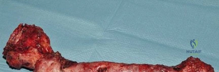 صورة طبية: جراحة استبدال مفصل الورك الملتهب في مرحلة واحدة: حل فعال وشامل مع الأستاذ الدكتور محمد هطيف
