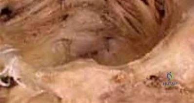 صورة طبية: دليل شامل لكسور وإصابات الجهاز الحركي: رعاية متقدمة في صنعاء مع الأستاذ الدكتور محمد هطيف
