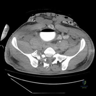 صورة طبية: دليل شامل لكسور وإصابات الجهاز الحركي: رعاية متقدمة في صنعاء مع الأستاذ الدكتور محمد هطيف