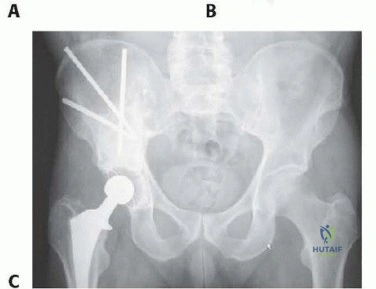صورة توضيحية لـ استعادة الحركة بعد سرطان الورك: جراحة استبدال مفصل الورك الكلي للآفات الخبيثة مع الأستاذ الدكتور محمد هطيف في صنعاء