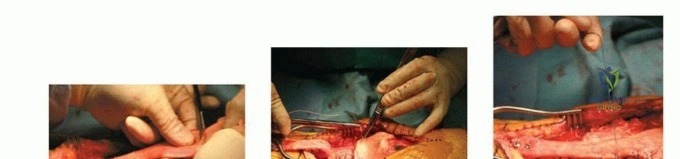 صورة طبية: تمزق وتر الرضفة بعد جراحة الركبة الصناعية المراجعة: حلول العلاج والتعافي مع الأستاذ الدكتور محمد هطيف