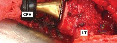 صورة طبية: إتقان توازن الأنسجة الرخوة لمفصل ورك صناعي مثالي: دليل شامل للمرضى مع الأستاذ الدكتور محمد هطيف