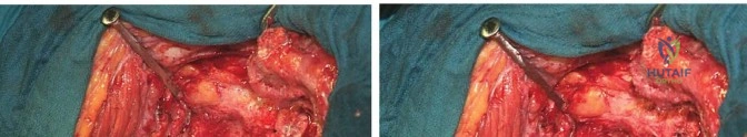 صورة طبية: جراحة استبدال مفصل الورك الملتهب في مرحلة واحدة: حل فعال وشامل مع الأستاذ الدكتور محمد هطيف
