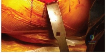 صورة طبية: ساق الفخذ المدبب: دليل شامل لتثبيت مفصل الورك اللاأسمنتي طويل الأمد مع الأستاذ الدكتور محمد هطيف في صنعاء