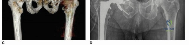 صورة طبية: إتقان مراجعة استبدال مفصل الورك: استراتيجيات تحديات الأنسجة المحلية الضارة