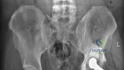 صورة شعاعية أمامية خلفية للحوض توضح مفصل ورك صناعي مثبت بالأسمنت مع انحراف رأس عظم الفخذ داخل البطانة البولي إيثيلين.