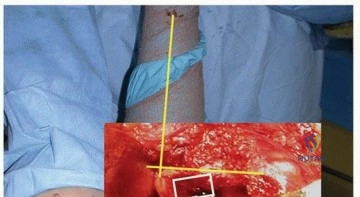 صورة توضيحية لـ السيقان المخروطية المزدوجة في مفصل الورك: ثبات يدوم لسنوات طويلة مع الأستاذ الدكتور محمد هطيف