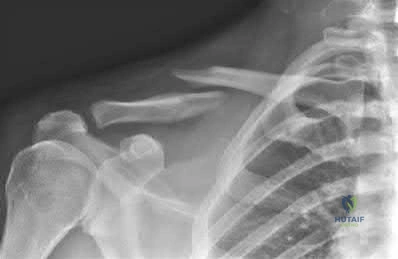 صورة طبية: دليل شامل لكسور وإصابات الجهاز الحركي: رعاية متقدمة في صنعاء مع الأستاذ الدكتور محمد هطيف