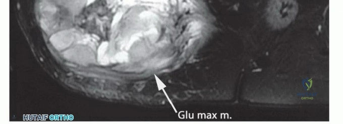صورة توضيحية لورم في الأرداف يظهر نشاطًا أيضيًا عاليًا في فحص PET CT
