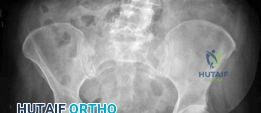 صورة توضيحية لـ جراحة استبدال مفصل الورك الهجين لكسور عنق الفخذ المتبدلة دليل شامل للمرضى مع الأستاذ الدكتور محمد هطيف