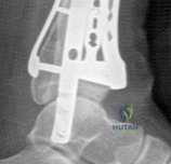Distal Radius Fracture: Ace Your FRCS Oral Exam Case