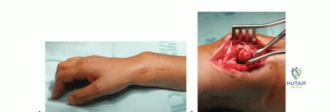كسور الكاحل: كيف تعالجها وتعود لأنشطتك الطبيعية بخطوات مثبتة