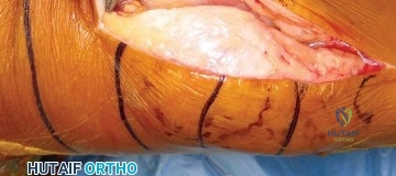 صورة طبية: استبدال مفصل الركبة بالحد الأدنى من التدخل الجراحي: ألم أقل وتعافٍ أسرع مع النهج شبه الرضفي الإنسي