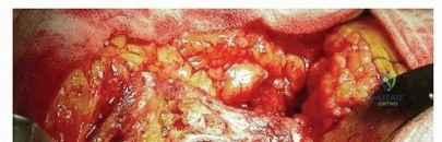 صورة طبية: استبدال مفصل الورك الكلي بالإسمنت الطبي: حل ناجح وموثوق لاستعادة الحركة
