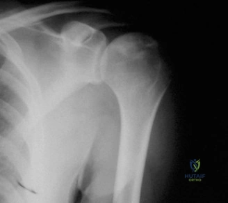 صورة طبية: آلام الكتف والمرفق: دليلك الشامل للتشخيص الدقيق والعلاج الفعال في صنعاء مع الأستاذ الدكتور محمد هطيف