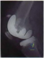 Test Your EDS Orthopaedic Knowledge: Hip & Knee Reconstruction MCQs