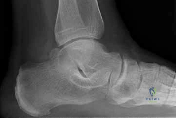 Orthopedic Foot And Ank Review | Dr Hutaif Foot & Ankle -...