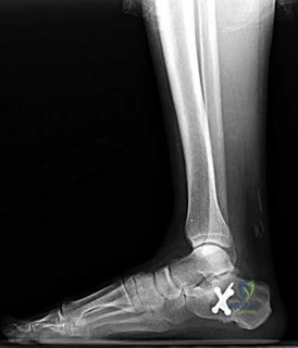 Orthopedic Foot And Ank Review | Dr Hutaif Foot & Ankle -...