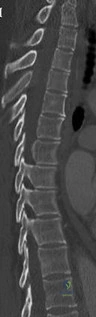 Orthopedic Spine MCQs: Don't just pmid view abstract, master the topic!