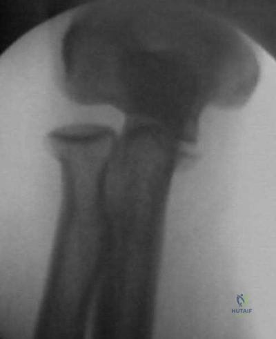 Improve Patients Femur Fracture Outcomes: Key Insights & MCQs