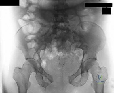 Illustration 145 for OrthoCash: Trauma MCQs & Cases for a yearold woman