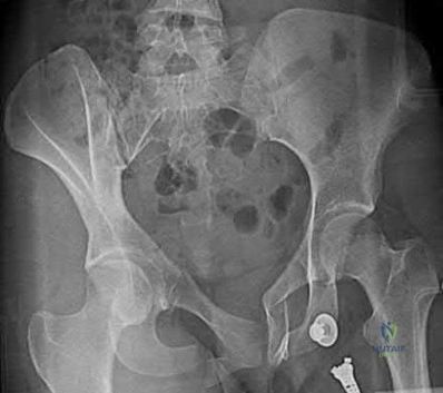 Illustration 134 for OrthoCash: Trauma MCQs & Cases for a yearold woman