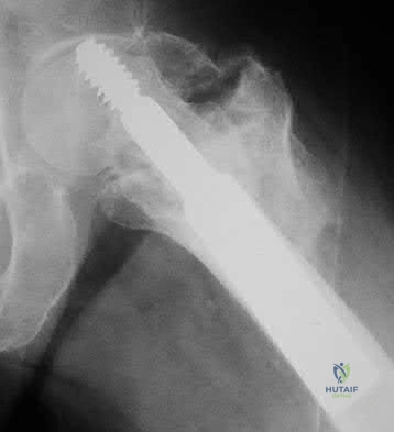 Illustration 51 for OrthoCash: Trauma MCQs & Cases for a yearold woman