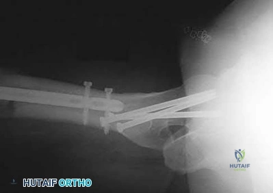 Illustration 112 for OrthoCash: Trauma MCQs & Cases for a yearold woman