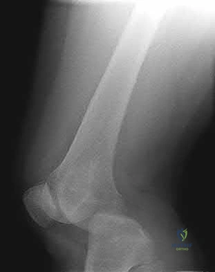 Illustration 163 for OrthoCash: Trauma MCQs & Cases for a yearold woman