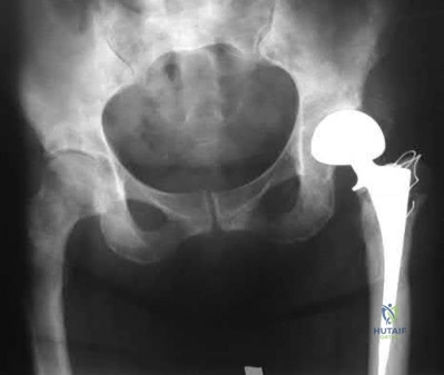 Illustration 66 for OrthoCash: Trauma MCQs & Cases for a yearold woman