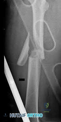 Illustration 110 for OrthoCash: Trauma MCQs & Cases for a yearold woman