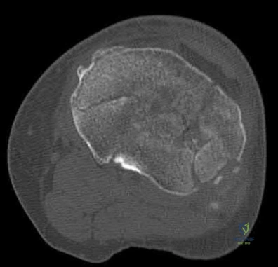 Illustration 185 for OrthoCash: Trauma MCQs & Cases for a yearold woman
