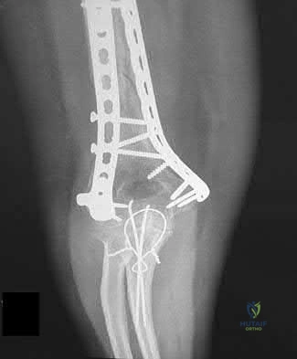 Illustration 79 for OrthoCash: Trauma MCQs & Cases for a yearold woman