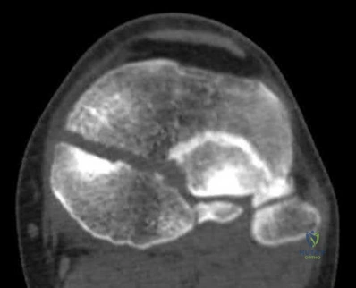 Illustration 40 for OrthoCash: Trauma MCQs & Cases for a yearold woman