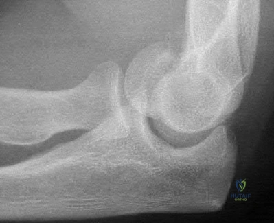Illustration 75 for OrthoCash: Trauma MCQs & Cases for a yearold woman