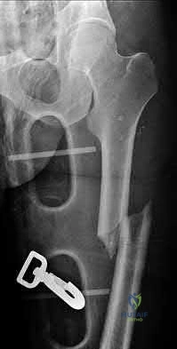 Illustration 176 for OrthoCash: Trauma MCQs & Cases for a yearold woman