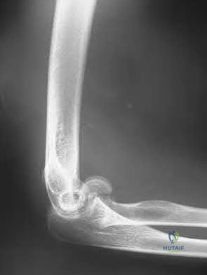 Illustration 199 for OrthoCash: Trauma MCQs & Cases for a yearold woman